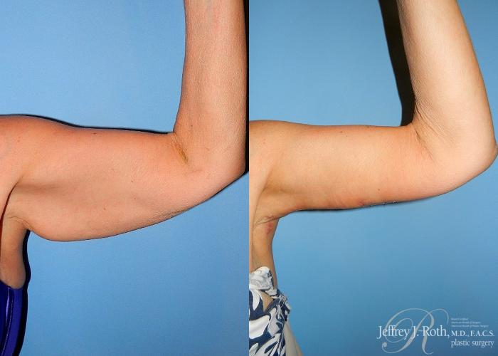 Before & After Arm Lift Case 1 View #1 View in Las Vegas, NV
