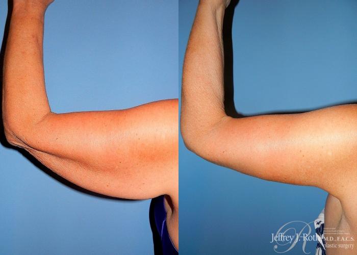 Before & After Arm Lift Case 1 View #2 View in Las Vegas, NV