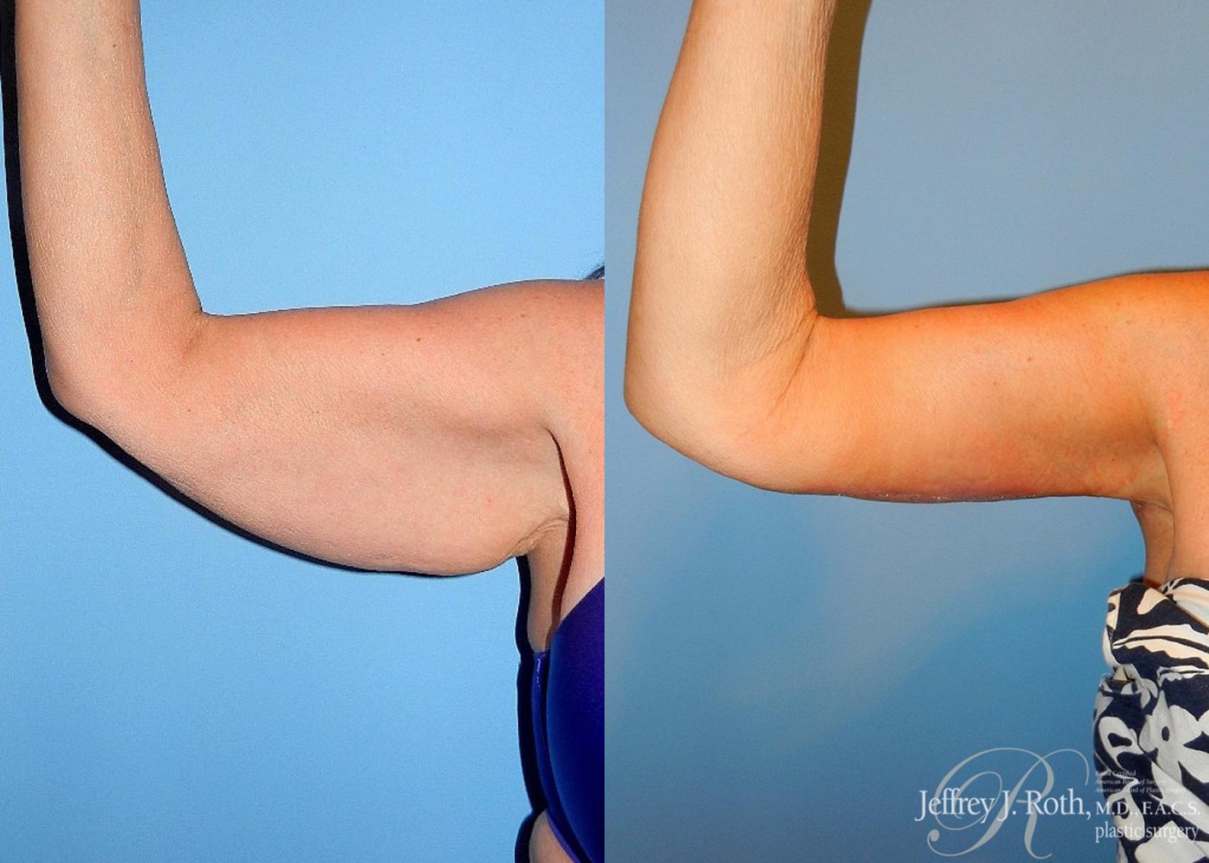 Before & After Arm Lift Case 1 View #3 View in Las Vegas, NV