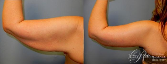 Before & After Arm Lift Case 2 View #1 View in Las Vegas and Henderson, NV