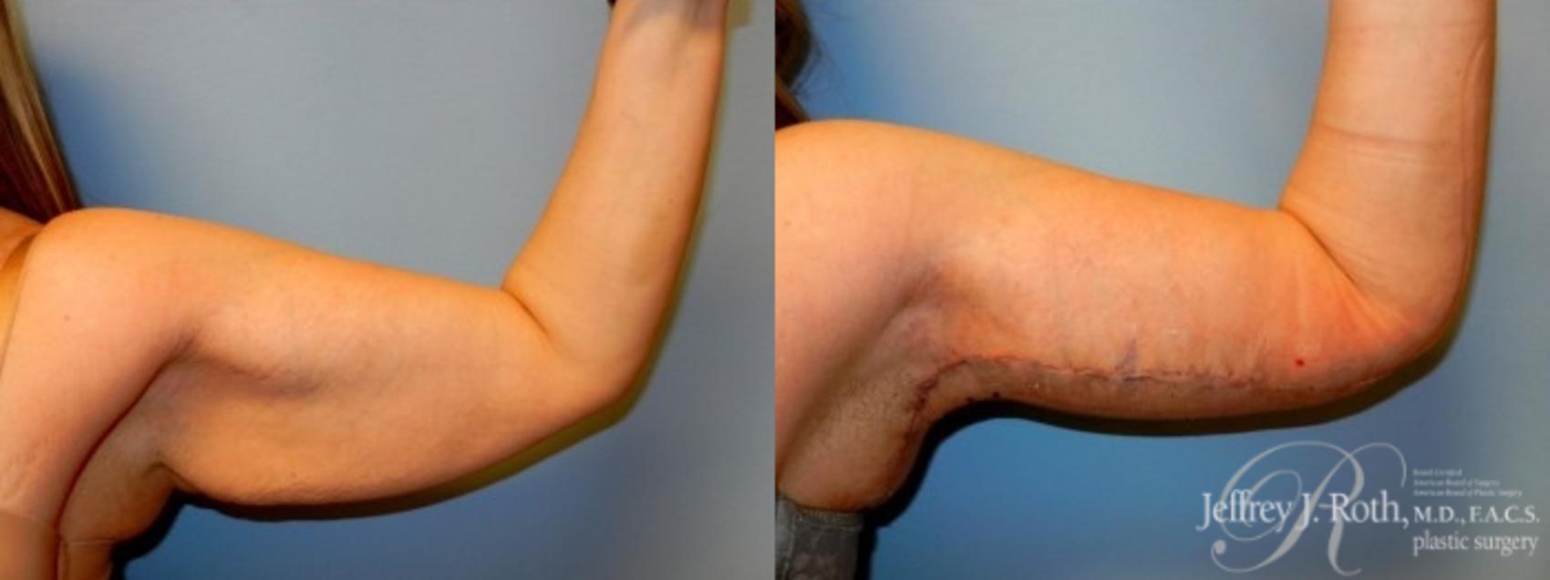 Before & After Arm Lift Case 2 View #2 View in Las Vegas, NV
