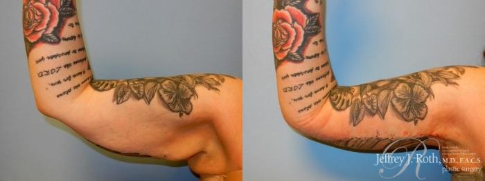 Before & After Arm Lift Case 2 View #4 View in Las Vegas and Henderson, NV