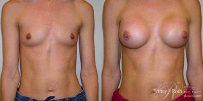 Before & After Breast Augmentation Case 178 Front View in Las Vegas and Henderson, NV