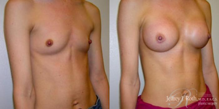 Before & After Breast Augmentation Case 178 Right Oblique View in Las Vegas and Henderson, NV