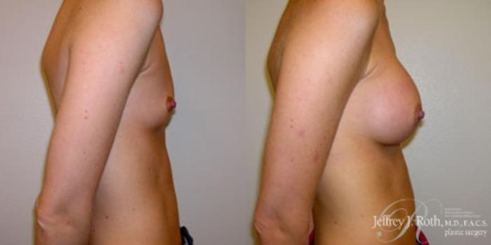 Before & After Breast Augmentation Case 178 Right Side View in Las Vegas and Henderson, NV