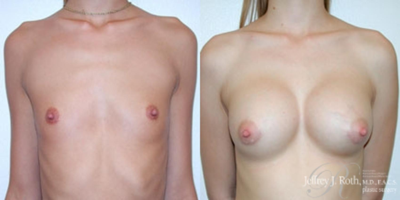 Before & After Breast Augmentation Case 179 Front View in Las Vegas, NV