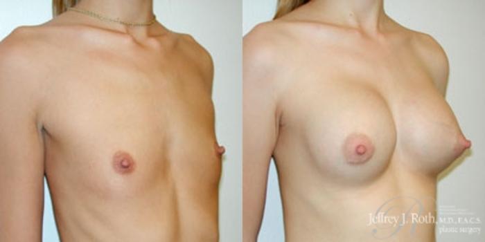 Before & After Breast Augmentation Case 179 Right Oblique View in Las Vegas and Henderson, NV