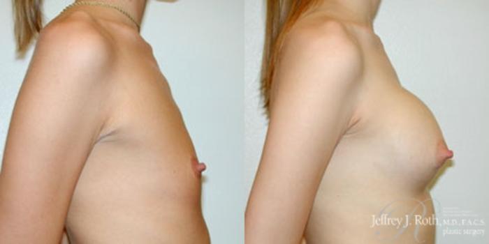 Before & After Breast Augmentation Case 179 Right Side View in Las Vegas and Henderson, NV