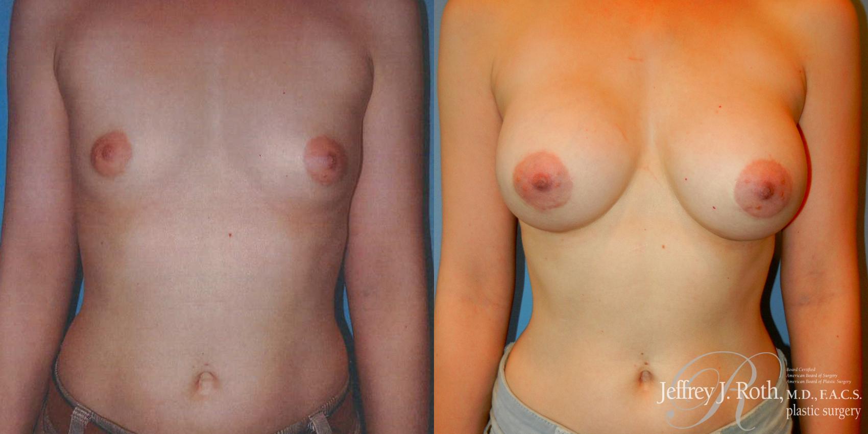 Before & After Breast Augmentation Case 180 Front View in Las Vegas, NV