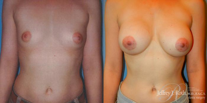 Before & After Breast Augmentation Case 180 Front View in Las Vegas and Henderson, NV