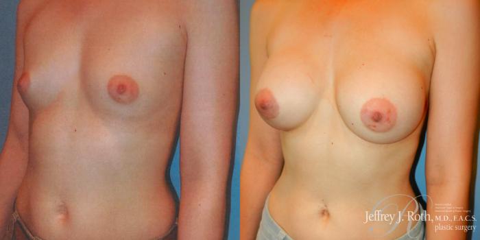 Before & After Breast Augmentation Case 180 Left Oblique View in Las Vegas and Henderson, NV