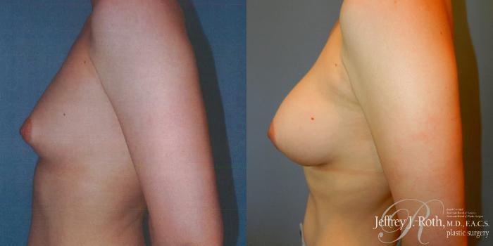 Before & After Breast Augmentation Case 180 Left Side View in Las Vegas and Henderson, NV