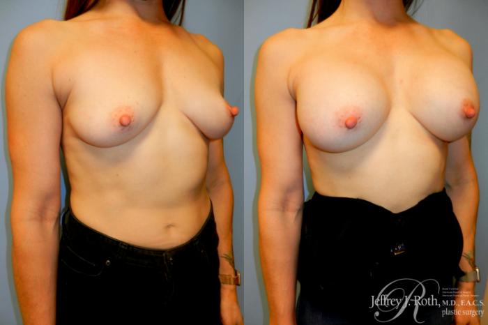 Before & After Breast Augmentation Case 182 Right Oblique View in Las Vegas and Henderson, NV