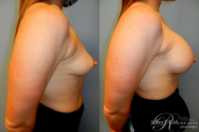 Before & After Breast Augmentation Case 182 Right Side View in Las Vegas and Henderson, NV