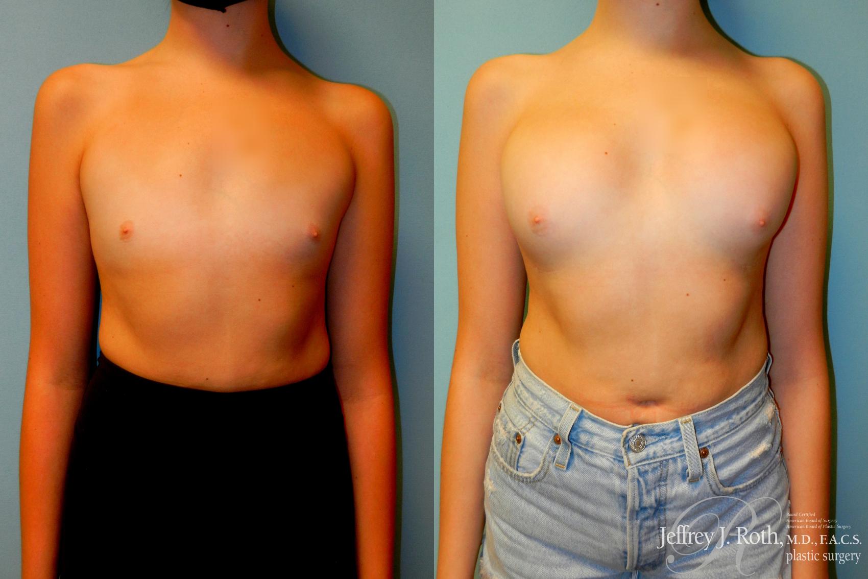 Before & After Breast Augmentation Case 183 Front View in Las Vegas, NV