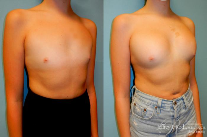 Before & After Breast Augmentation Case 183 Right Oblique View in Las Vegas and Henderson, NV