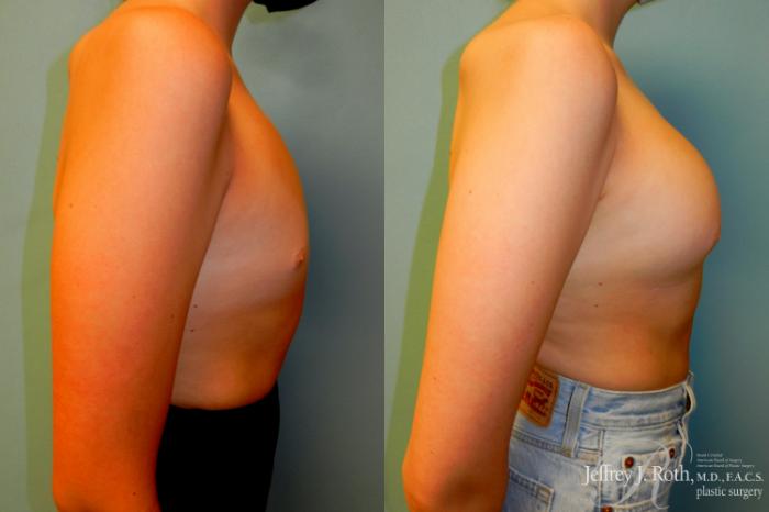 Before & After Breast Augmentation Case 183 Right Side View in Las Vegas and Henderson, NV