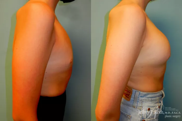 Tummy Tuck (Abdominoplasty) Before and After Pictures Case 183