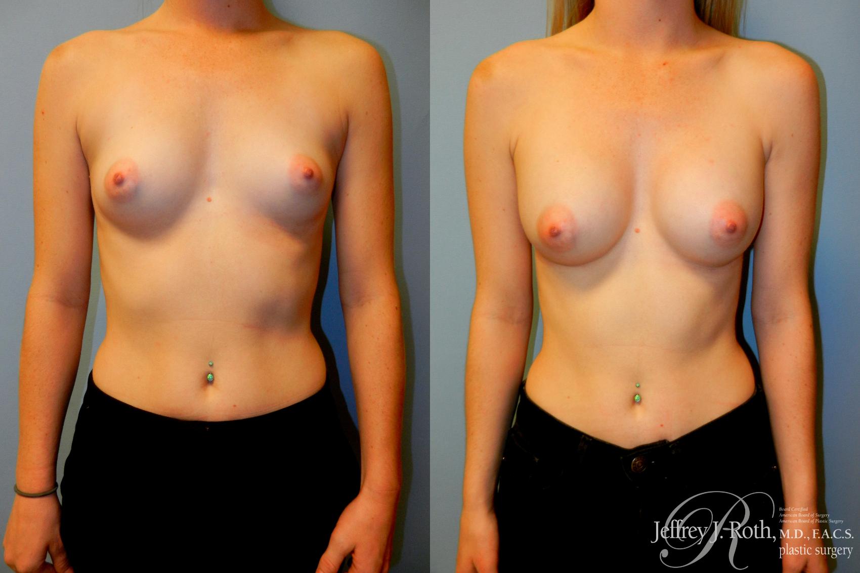 Before & After Breast Augmentation Case 184 Front View in Las Vegas, NV