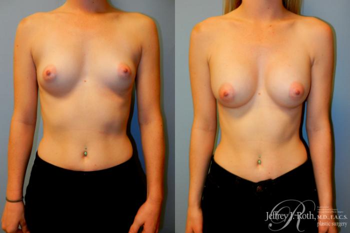 Before & After Breast Augmentation Case 184 Front View in Las Vegas and Henderson, NV