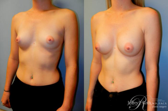 Before & After Breast Augmentation Case 184 Left Oblique View in Las Vegas and Henderson, NV