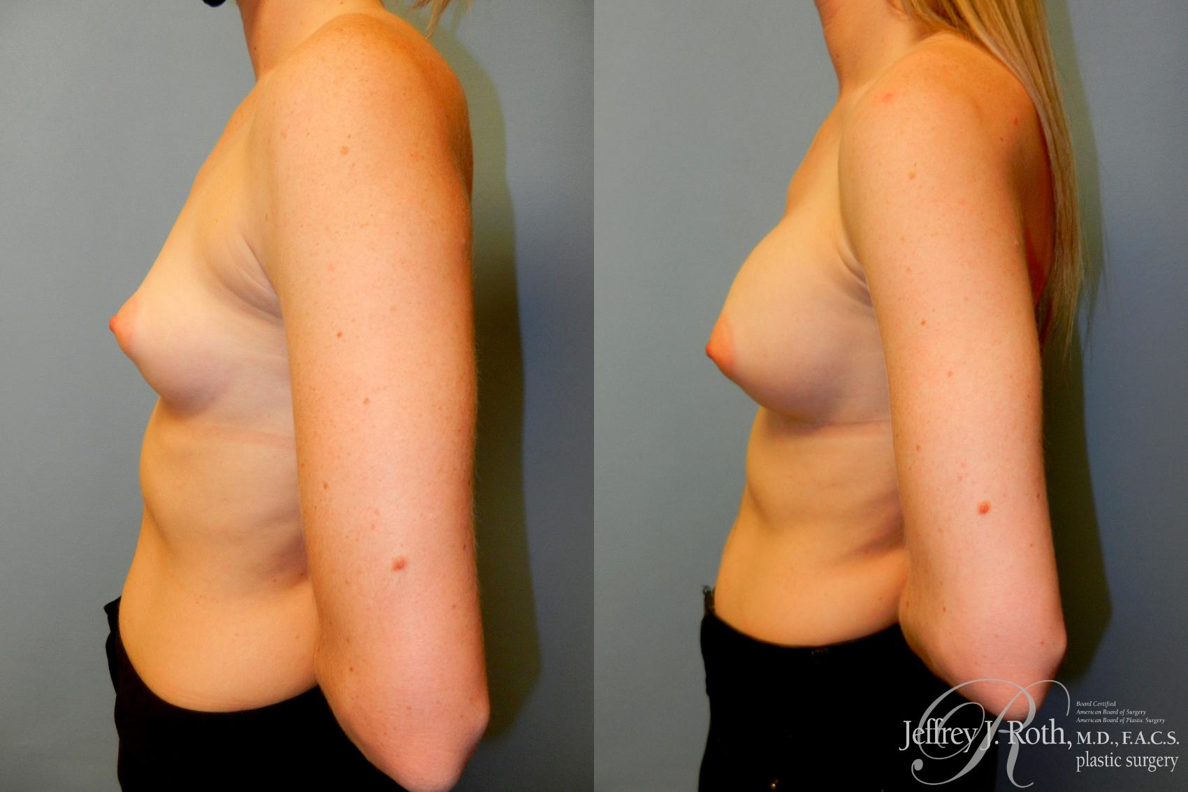 Before & After Breast Augmentation Case 184 Left Side View in Las Vegas, NV