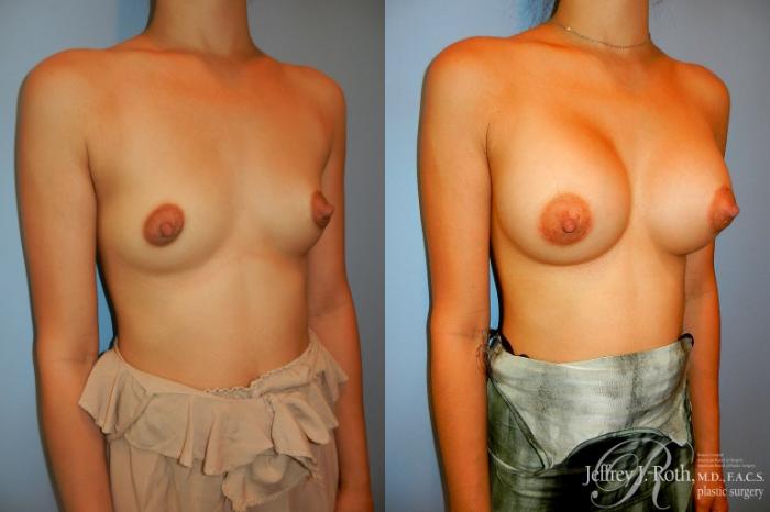 Before & After Breast Augmentation Case 185 Right Oblique View in Las Vegas and Henderson, NV