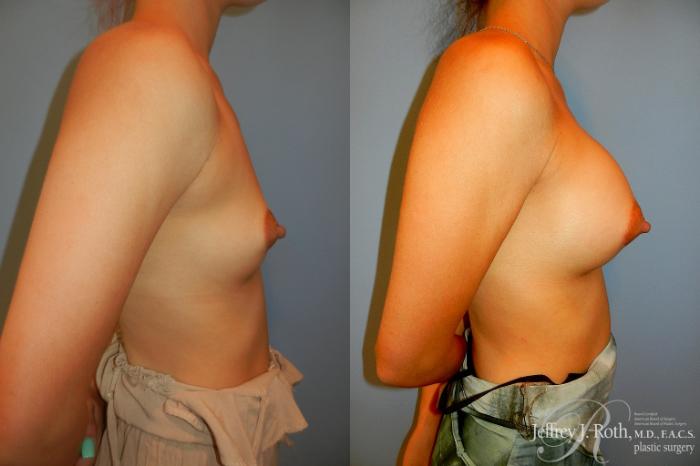 Before & After Breast Augmentation Case 185 Right Side View in Las Vegas and Henderson, NV