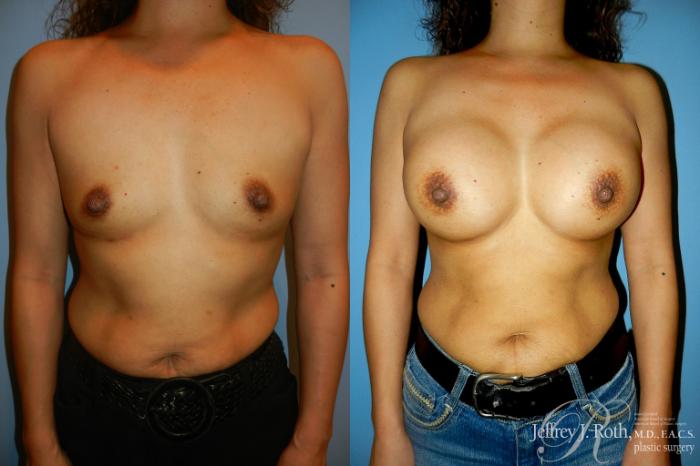 Before & After Breast Augmentation Case 186 Front View in Las Vegas and Henderson, NV