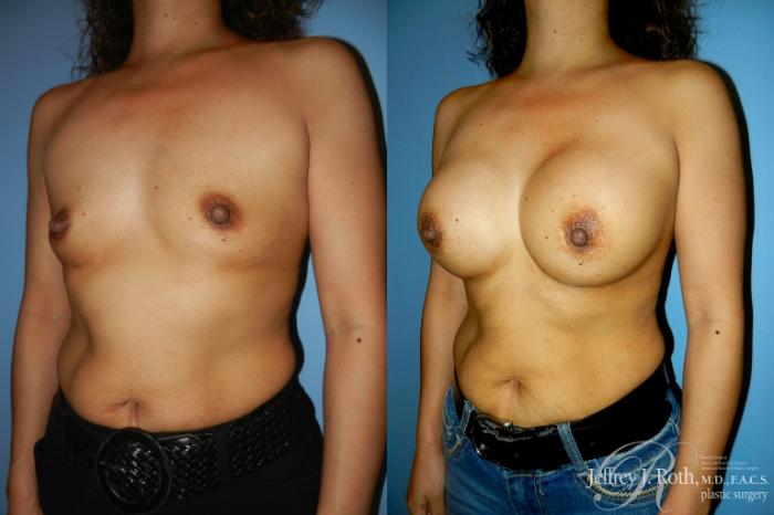 Before & After Breast Augmentation Case 186 Left Oblique View in Las Vegas and Henderson, NV