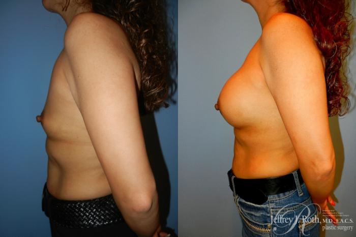 Before & After Breast Augmentation Case 186 Left Side View in Las Vegas and Henderson, NV