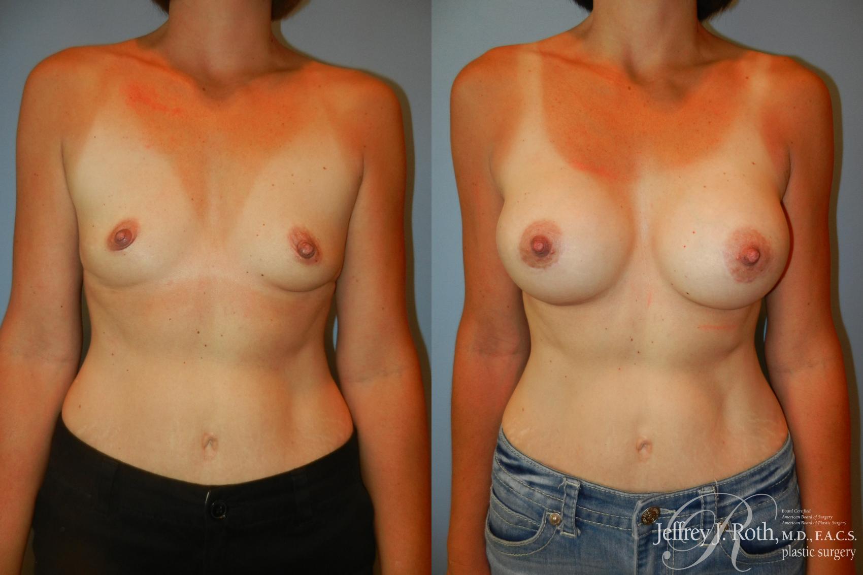 Before & After Breast Augmentation Case 187 Front View in Las Vegas, NV