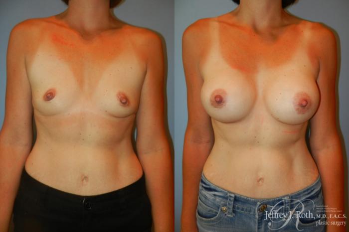 Before & After Breast Augmentation Case 187 Front View in Las Vegas and Henderson, NV