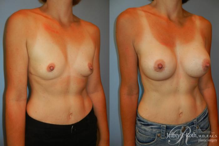 Before & After Breast Augmentation Case 187 Right Oblique View in Las Vegas and Henderson, NV