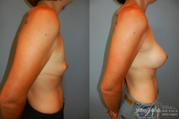 Before & After Breast Augmentation Case 187 Right Side View in Las Vegas and Henderson, NV