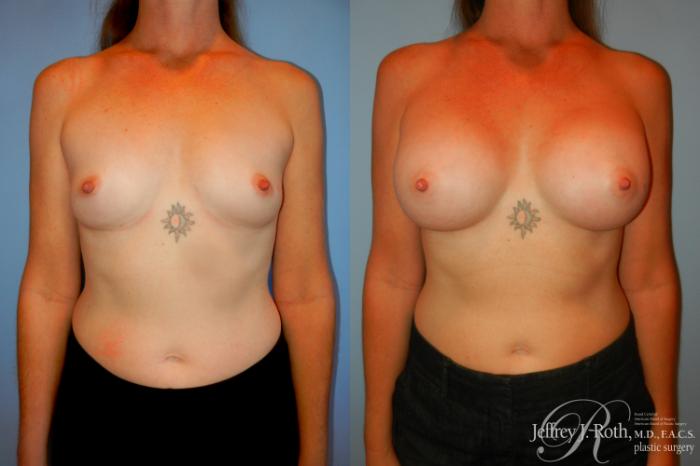 Before & After Breast Augmentation Case 188 Front View in Las Vegas and Henderson, NV