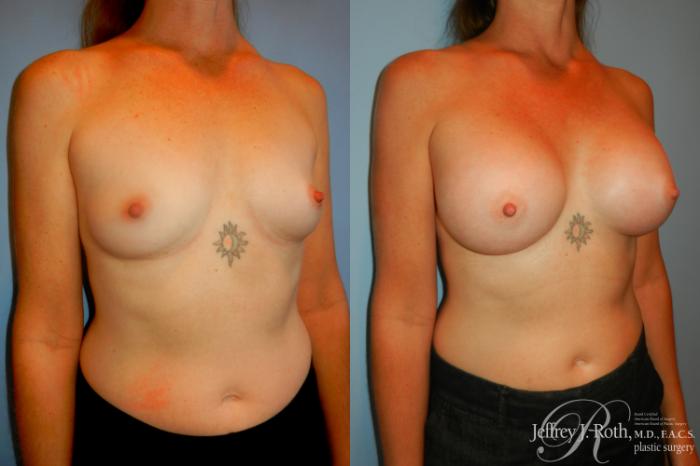 Before & After Breast Augmentation Case 188 Right Oblique View in Las Vegas and Henderson, NV