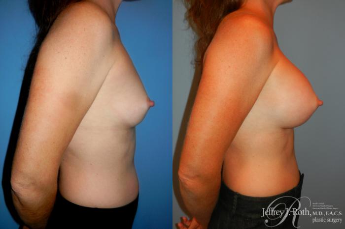Before & After Breast Augmentation Case 188 Right Side View in Las Vegas and Henderson, NV