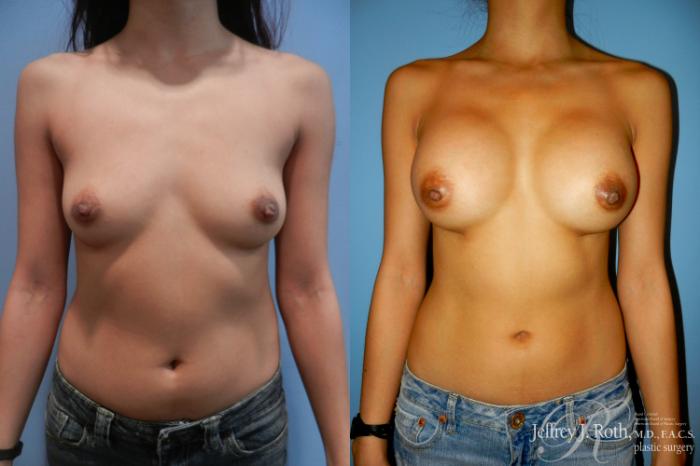 Before & After Breast Augmentation Case 190 Front View in Las Vegas and Henderson, NV