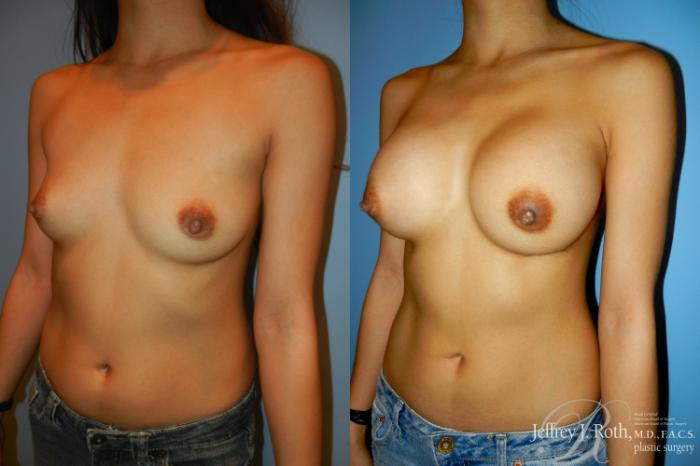 Before & After Breast Augmentation Case 190 Left Oblique View in Las Vegas and Henderson, NV