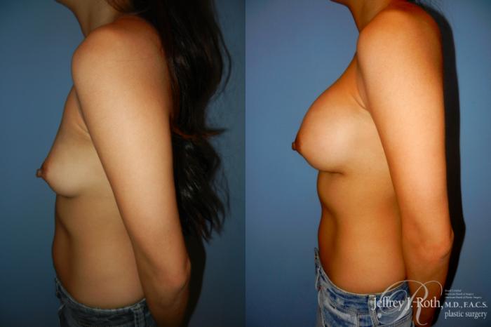 Before & After Breast Augmentation Case 190 Left Side View in Las Vegas and Henderson, NV