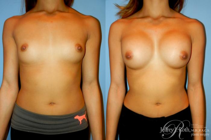 Before & After Breast Augmentation Case 191 Front View in Las Vegas, NV
