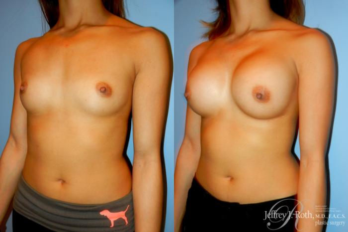 Before & After Breast Augmentation Case 191 Left Oblique View in Las Vegas, NV