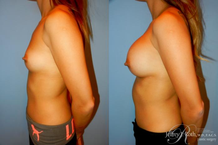 Before & After Breast Augmentation Case 191 Left Side View in Las Vegas, NV