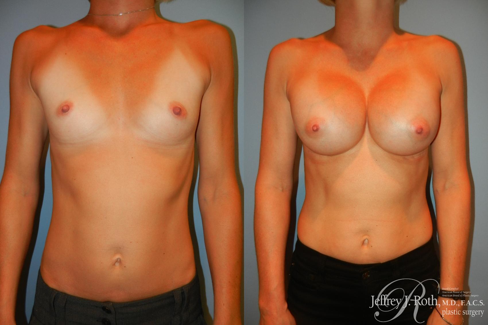 Before & After Breast Augmentation Case 192 Front View in Las Vegas, NV