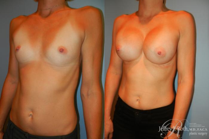 Before & After Breast Augmentation Case 192 Left Oblique View in Las Vegas and Henderson, NV