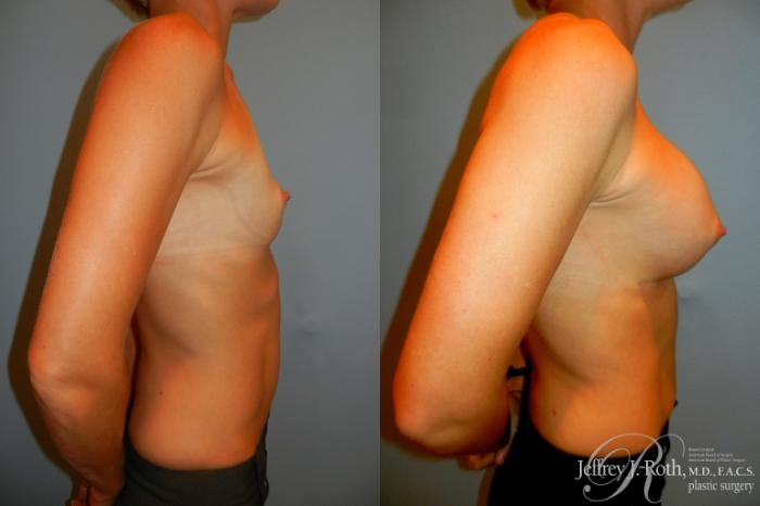 Before & After Breast Augmentation Case 192 Right Side View in Las Vegas and Henderson, NV