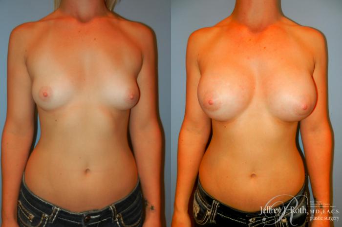 Before & After Breast Augmentation Case 193 Front View in Las Vegas and Henderson, NV