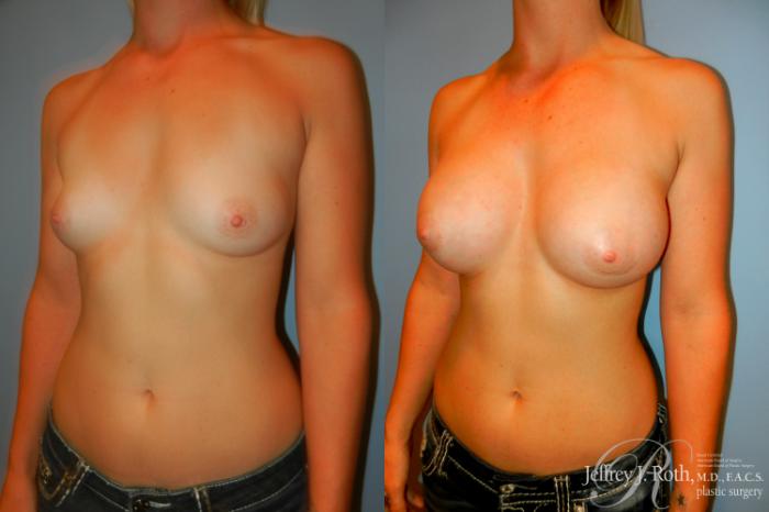Before & After Breast Augmentation Case 193 Left Oblique View in Las Vegas and Henderson, NV