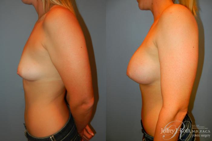 Before & After Breast Augmentation Case 193 Left Side View in Las Vegas and Henderson, NV